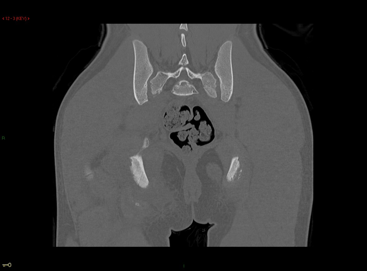 Figure 3 for case Ischial tuberosity ( RID2550 ) avulsion